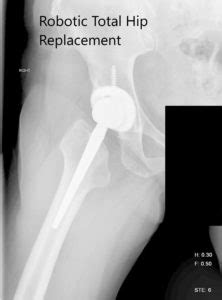 Case Study Right Hip Arthritis With Robotic Replacement
