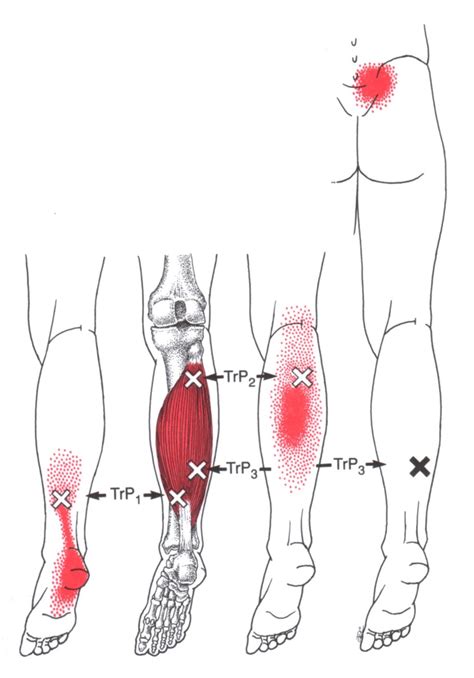The Trigger Point And Referred Pain Guide 10
