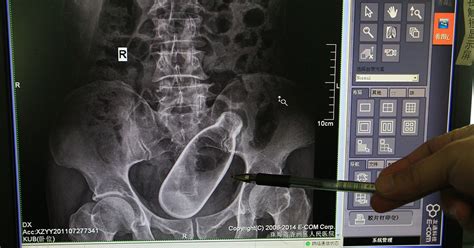 Shocking Hospital X Ray Shows Man With Bottle Stuck Inside Him Daily