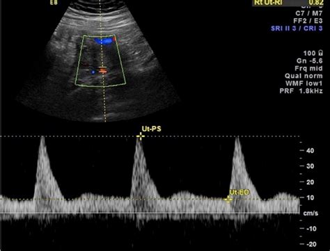 Uterine Artery Doppler Of The Gravid Uterus As A Predictor Identifying