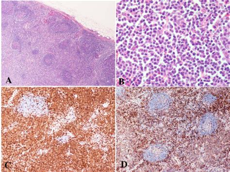 Peripheral T Cell Lymphoma Unspecified Submental Lymph Node Biopsy