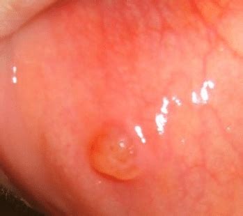 Today this article will explain why the roof a small, sometimes slightly painful bump on the roof of your mouth is generally harmless and clears up within a week or so. Bump on Roof of Mouth, Painful, Hard, White, Red, Small ...