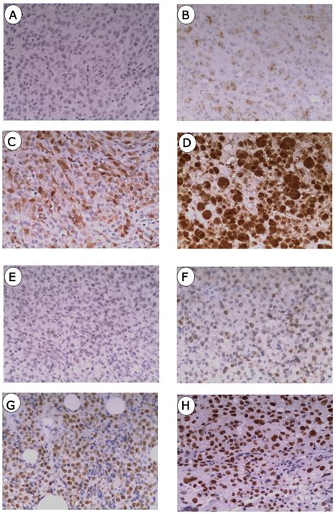 Immunostainings Of P16 And P53 In Mucosal Melanoma A Negative