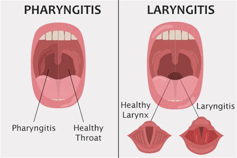 Pharyngitis Pictures