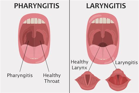 Can Strep Throat Get Worse After Starting Antibiotics