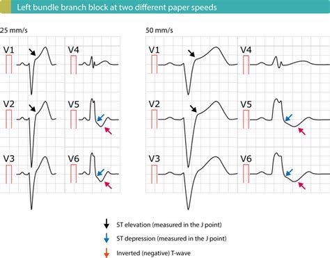 What Is A Left Bundle Branch Block Images And Photos Finder