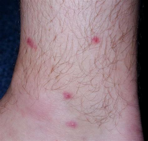 Red Splotches On Legs Not Itchy Pictures Photos