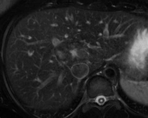 Liver Atlas Case 196 Focal Nodular Hyperplasia Fnh