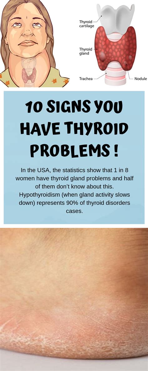 Thyroid Gland Problems In Females Symptoms
