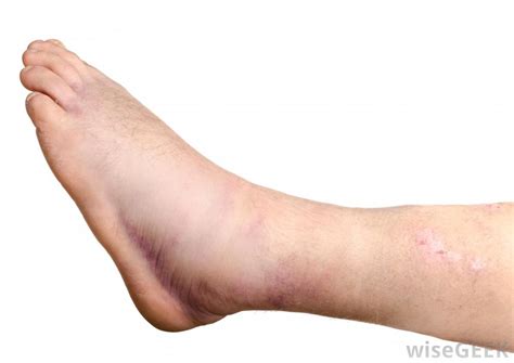 What Are The Common Causes Of Swelling In One Leg