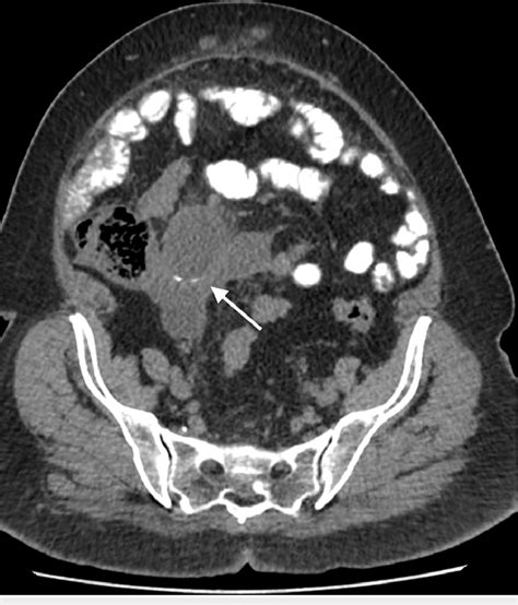 Axial Ct Imaging Of The Lower Abdomen With Administration Of Oral
