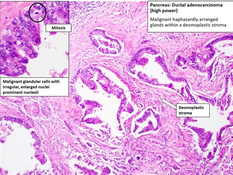 Pancreas Adenocarcinoma Nus Pathweb