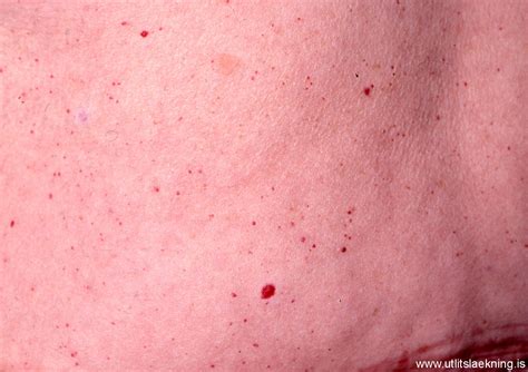 Hemangioma Cherry Angioma Vs Petechiae Red Dots On Skin August 2015