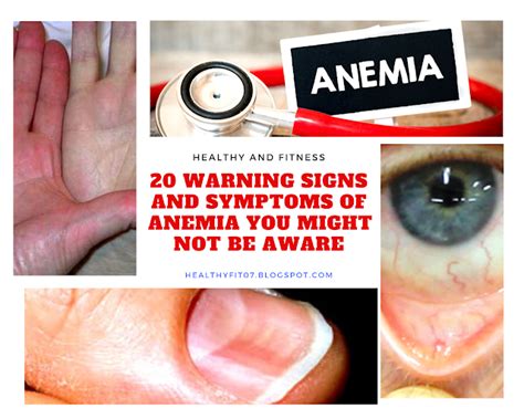 20 Warning Signs And Symptoms Of Anemia You Might Not Be Aware