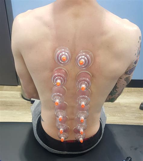 What Is Cupping ATP