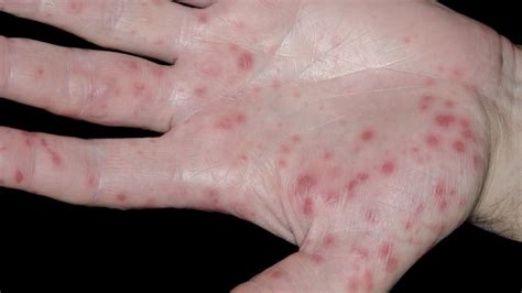 Hand, foot, and mouth disease (hfmd) is a common infection caused by a group of viruses. Hand, foot and mouth disease: First vaccine - BBC News