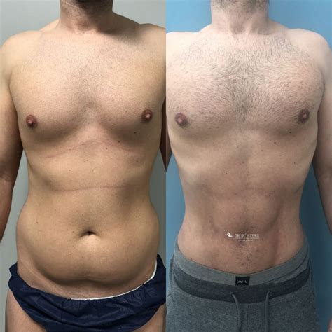 Arriba Foto Abdomen Carboxiterapia Antes Y Despues Fotos Alta