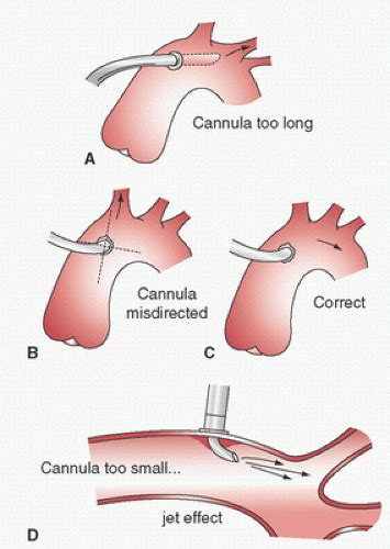 Blood Pumps Circuitry And Cannulation Techniques In Cardiopulmonary