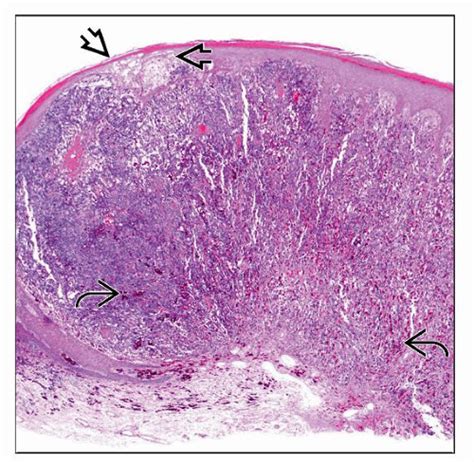 Melanoma Nodular Type Basicmedical Key