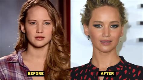 Jennifer Lawrence Plastic Surgery Teeth Before Veneers Weight Loss And Before After Pics