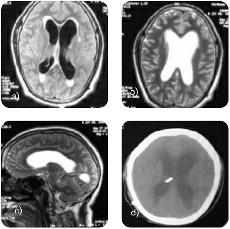 A Mri Brain Flair Axial Image Suggestive Of Dilatation Of Bilateral