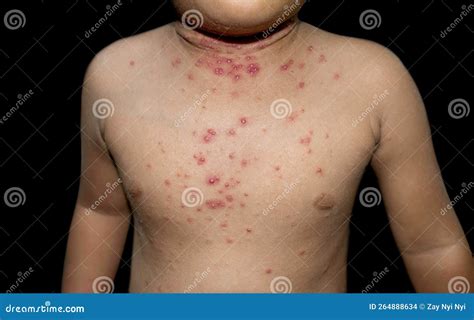 Molluscum Contagiosum Skin Lesions Also Called Water Warts Stock Photo
