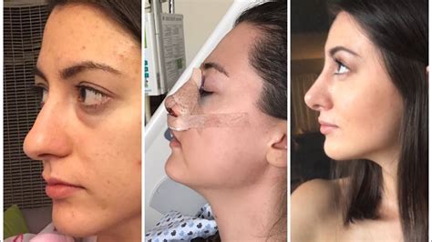 1 6 Months After Rhinoplasty Month By Month Nose Job Recovery Youtube