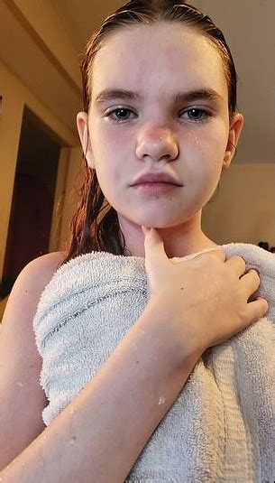 Dieses jährige Mädchen ist so allergisch gegen Wasser dass selbst eine Dusche für sie