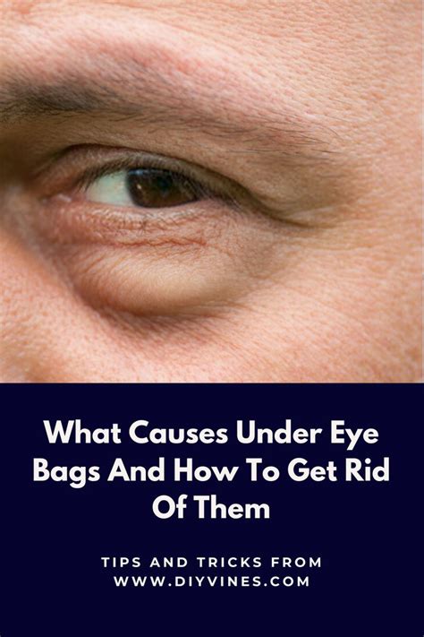 What Causes Under Eye Bags And How To Get Rid Of Them Eye Bags Under