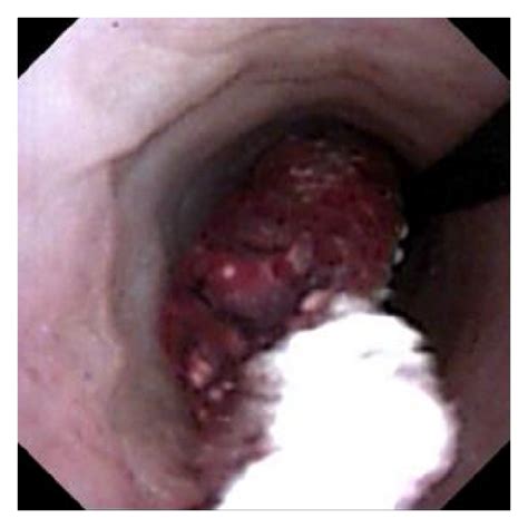 A Patient With Fibroepithelial Polyp Of The Uretera Rare Condition