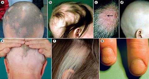 Alopecia Areata Causes Symptoms And Best Treatment For Alopecia Areata