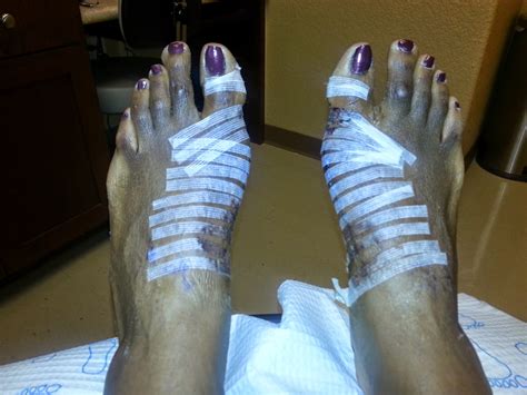 Double Scarf Akin Osteotomy Bilateral Bunionectomy Fixing My Feet