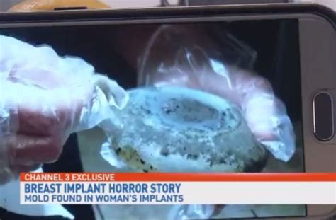 Florida Woman Discovers Mold In Her Breast Implants