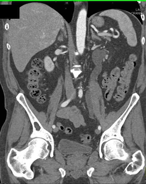 Bladder Cancer Obstructs The Left Ureter Genitourinary Case Studies