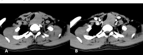 Figure 1 From Ct And Mr Imaging Of Thyroid Carcinoma Showing Thymus