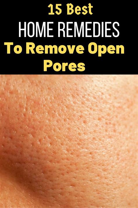 12 Home Remedies For Open Poresget Rid Of At Home
