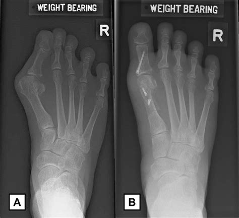 Clinical Outcomes Of Scarf Akin Osteotomy For Hallux Valgus With