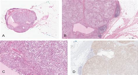 Lymph Node Involvement By A Clear Cell Nodular Hidradenoma L The