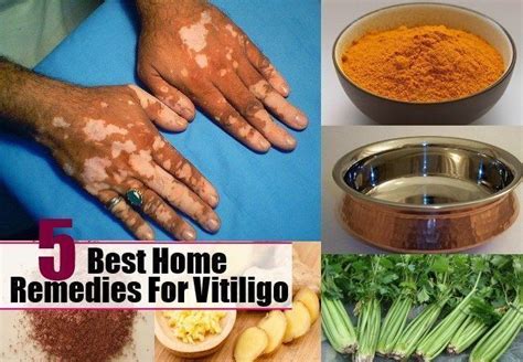 Remedies For Vitiligo Vitiligo Treatment Vitiligo Vitiligo Cure