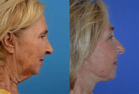 Facelift Photos Melbourne Fl Patient 16348