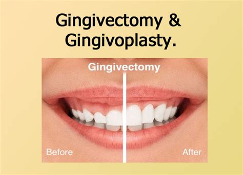 Gingivectomy And Gingivoplasty Focus Dentistry
