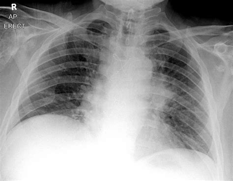 Small Cell Carcinoma Of The Lung X Ray Wikidoc