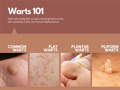 the derma corner the 101 on warts potential treatments and how to avoid them — project vanity