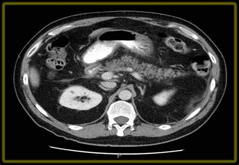 Ct Scan Of Pancreas With Contrast