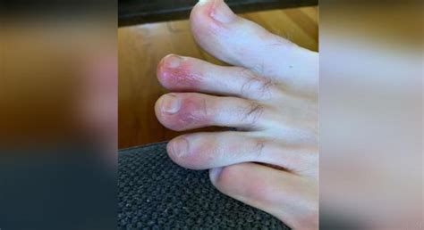 Some parents report that their kids' symptoms have lingered for months. Covid Toes — new symptom of coronavirus among kids ...
