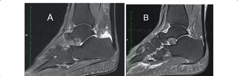 Mri Of The Ankle Of A Patient With Haap And In A Patient With