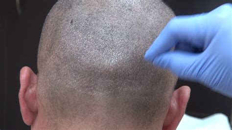 Fue Hair Transplant Donor Scar During One Year Follow Up By Dr Diep