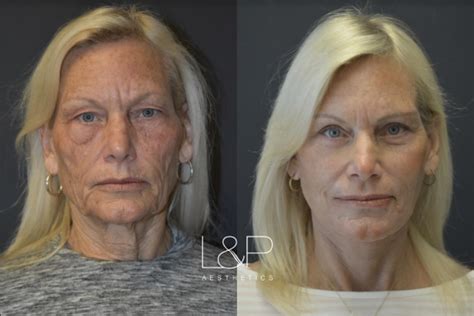 Facelift And Neck Lift Before And After Photos Case 23 Palo Alto And San