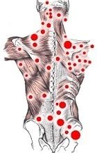 While trigger points are more often associated with myofascial pain syndrome, people with fibromyalgia may have both. 10 best images about fibromyalgie on Pinterest | Beautiful ...