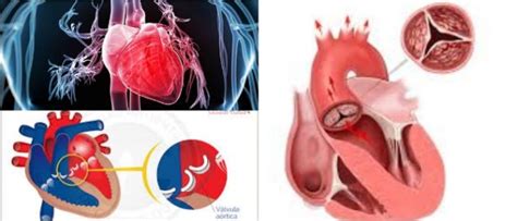 Válvula Aórtica Conoce Todo Lo Referente A Esta Válvula Del Corazón Y